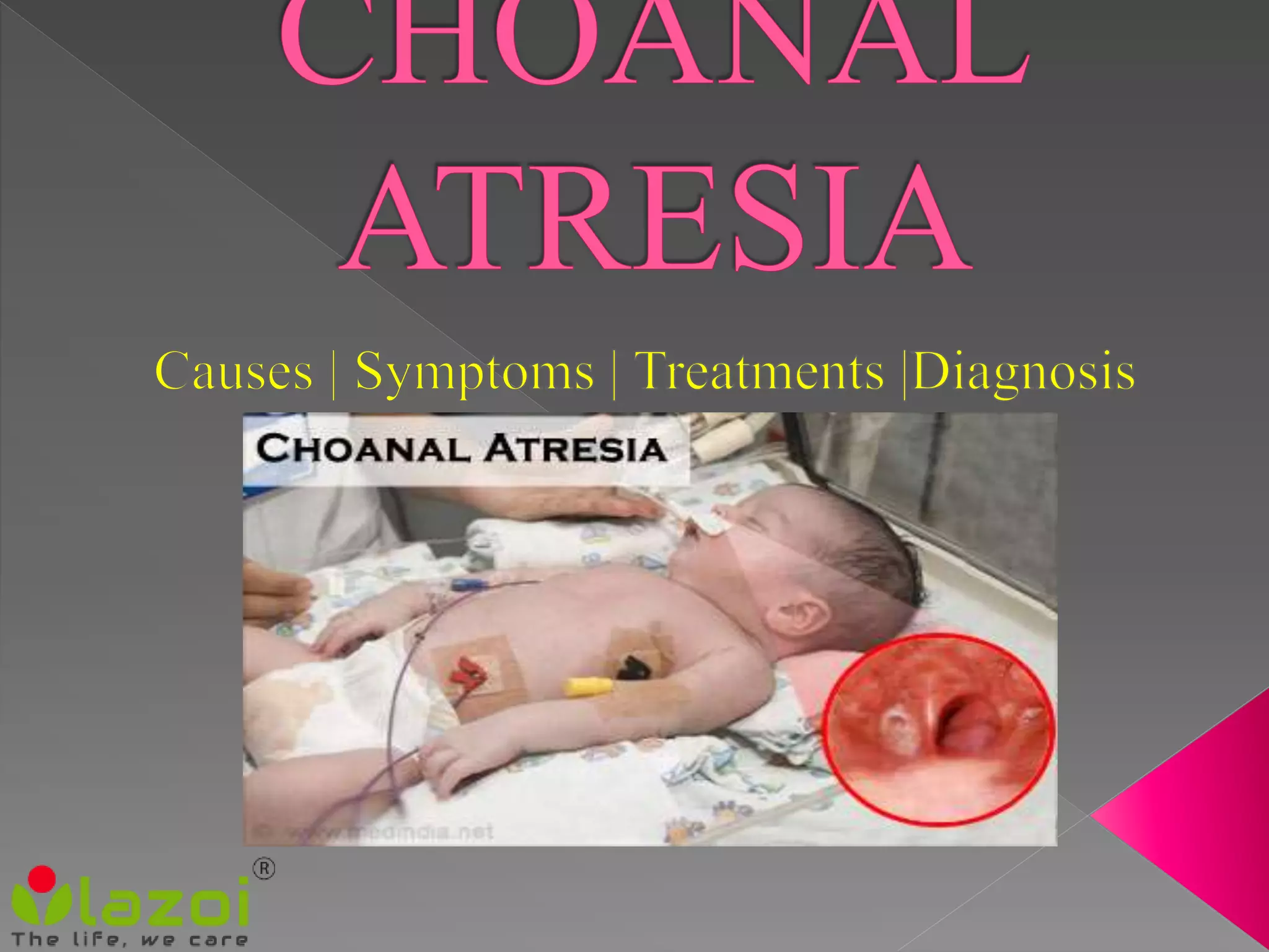 Choanal atresia: Symptoms, causes, treatment and Prevention. | PPTX