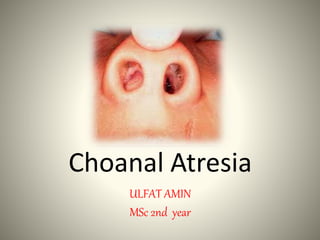 Choanal Atresia
ULFAT AMIN
MSc 2nd year
 