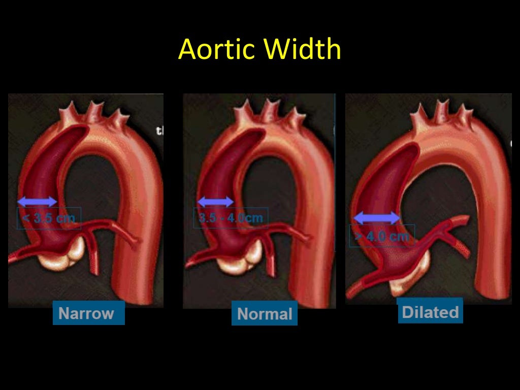 Choice of guiding catheters in PCI