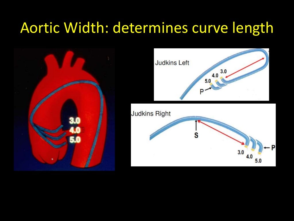 Choice of guiding catheters in PCI