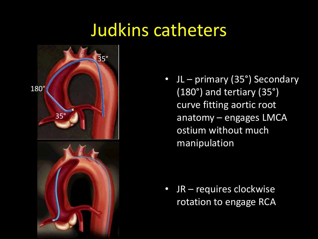 Choice of guiding catheters in PCI