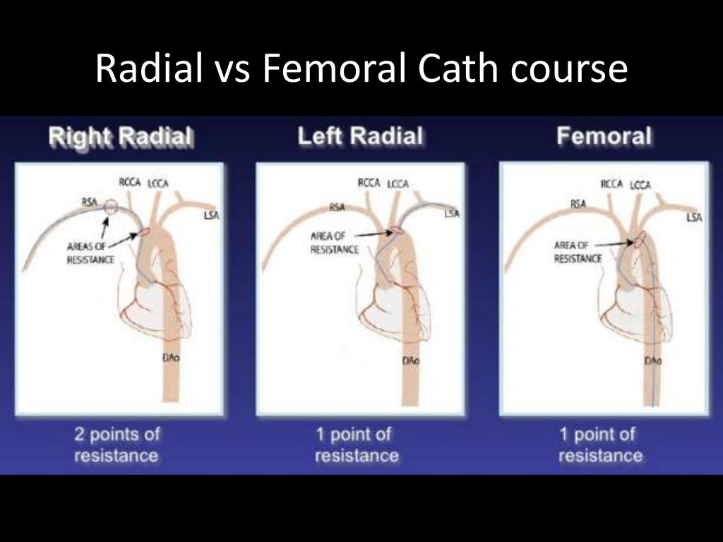 Choice of guiding catheters in PCI