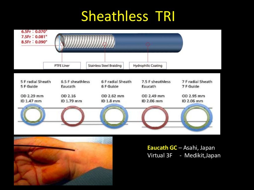 Choice of guiding catheters in PCI