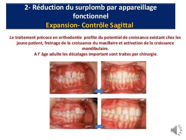 Choice Of Teeth For Extraction In Orthodontic Mohamad Aboualnaser O