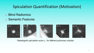 Spiculation Sign Radiomics in Lung Cancer | PDF