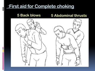 Choking Management, for a school student | PPTX