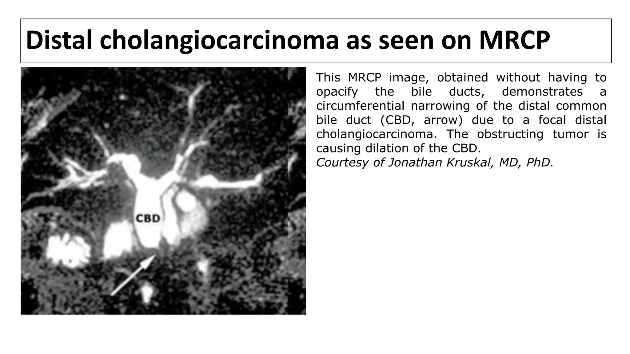 Distal cholangiocarcinoma as seen on MRCP
This MRCP image, obtained without having to
opacify the bile ducts, demonstrates a
circumferential narrowing of the distal common
bile duct (CBD, arrow) due to a focal distal
cholangiocarcinoma. The obstructing tumor is
causing dilation of the CBD.
Courtesy of Jonathan Kruskal, MD, PhD.
 