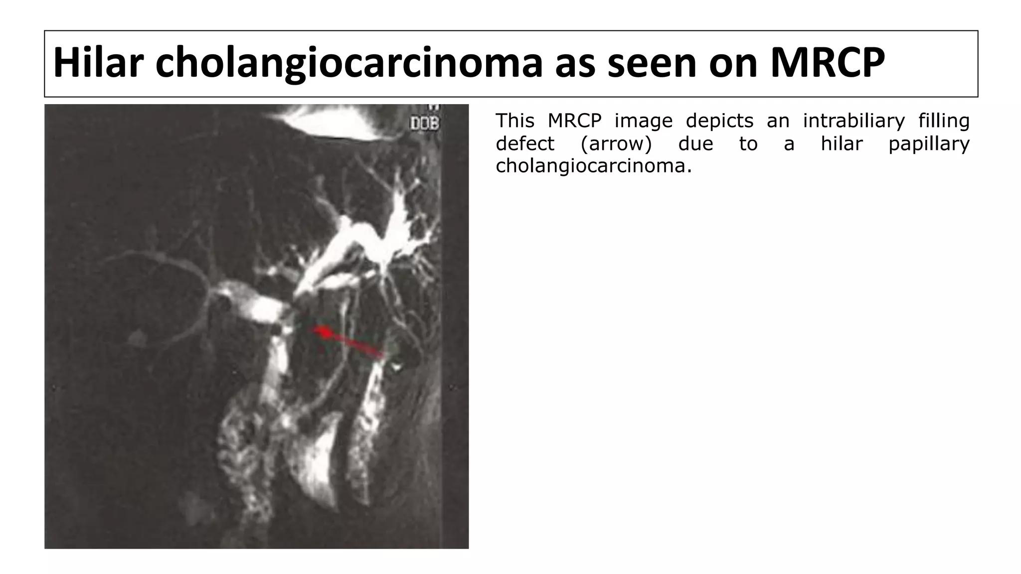 Hilar cholangiocarcinoma as seen on MRCP
This MRCP image depicts an intrabiliary filling
defect (arrow) due to a hilar papillary
cholangiocarcinoma.
 