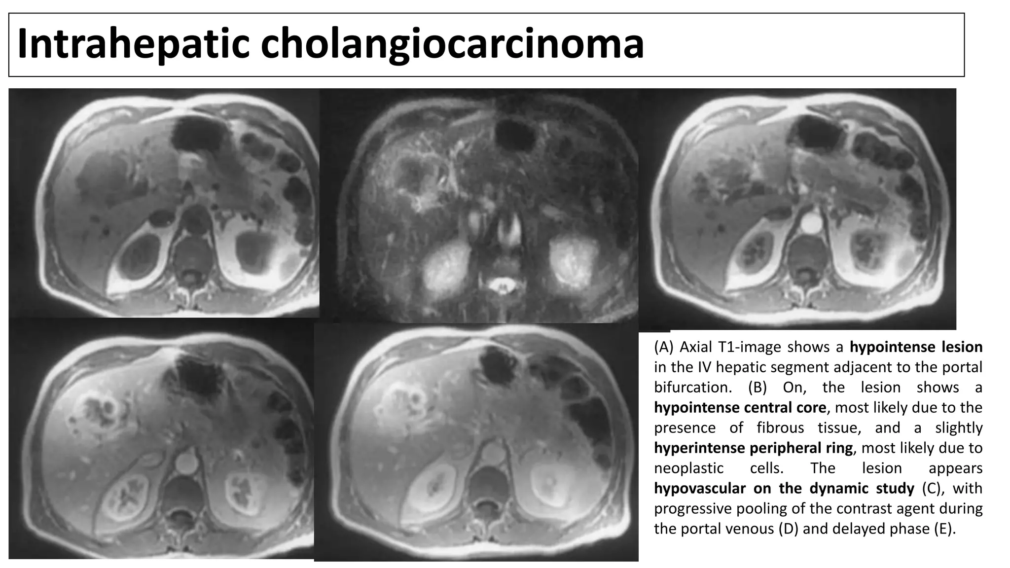Intrahepatic cholangiocarcinoma
(A) Axial T1-image shows a hypointense lesion
in the IV hepatic segment adjacent to the portal
bifurcation. (B) On, the lesion shows a
hypointense central core, most likely due to the
presence of fibrous tissue, and a slightly
hyperintense peripheral ring, most likely due to
neoplastic cells. The lesion appears
hypovascular on the dynamic study (C), with
progressive pooling of the contrast agent during
the portal venous (D) and delayed phase (E).
 