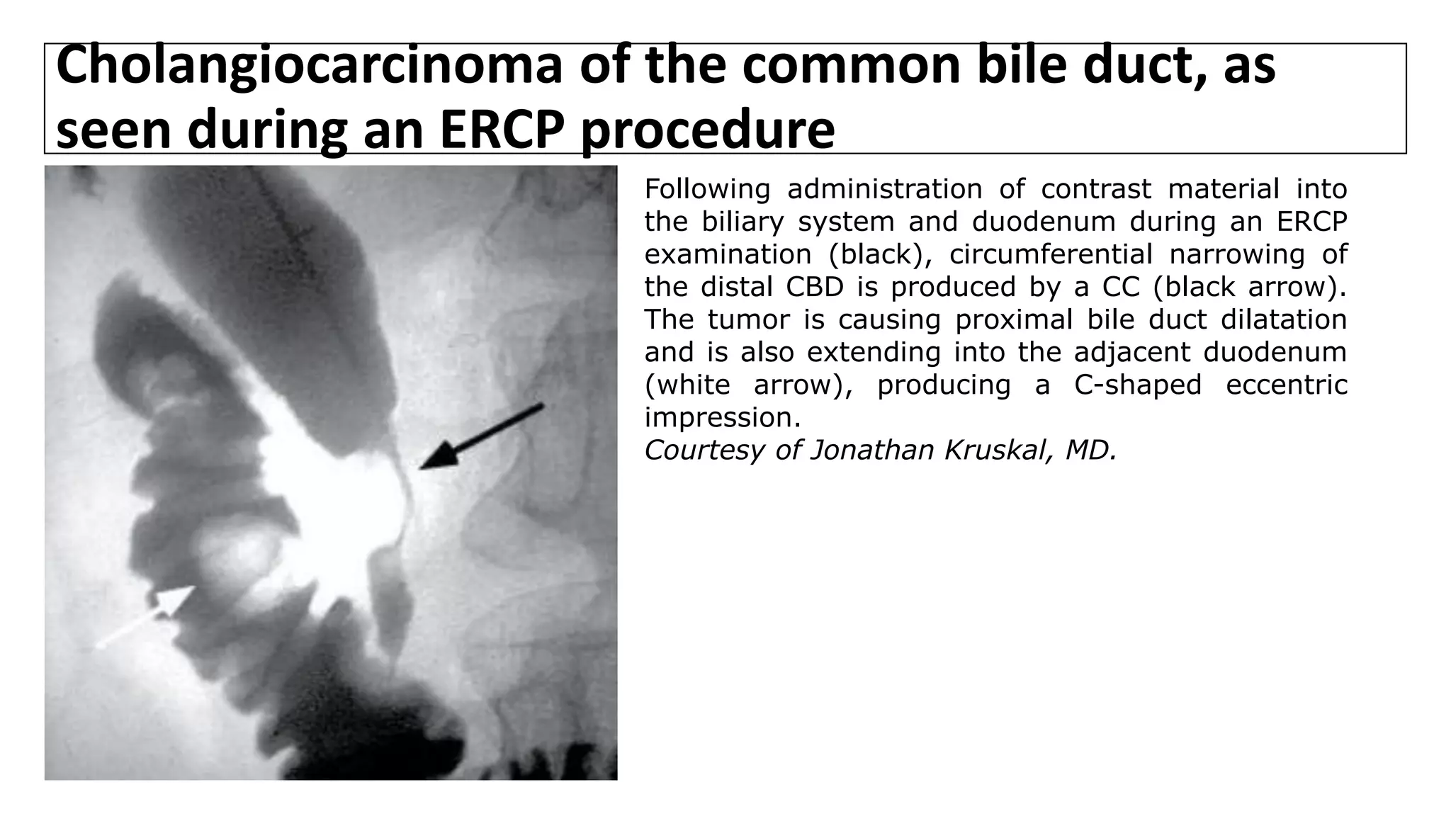 Cholangiocarcinoma of the common bile duct, as
seen during an ERCP procedure
Following administration of contrast material into
the biliary system and duodenum during an ERCP
examination (black), circumferential narrowing of
the distal CBD is produced by a CC (black arrow).
The tumor is causing proximal bile duct dilatation
and is also extending into the adjacent duodenum
(white arrow), producing a C-shaped eccentric
impression.
Courtesy of Jonathan Kruskal, MD.
 