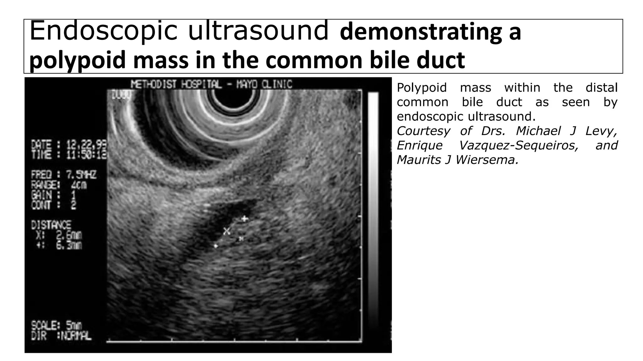 Endoscopic ultrasound demonstrating a
polypoid mass in the common bile duct
Polypoid mass within the distal
common bile duct as seen by
endoscopic ultrasound.
Courtesy of Drs. Michael J Levy,
Enrique Vazquez-Sequeiros, and
Maurits J Wiersema.
 