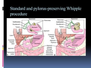 Standard and pylorus-preserving Whipple
procedure
 