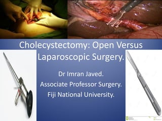 Cholecystectomy: Open Versus
Laparoscopic Surgery.
Dr Imran Javed.
Associate Professor Surgery.
Fiji National University.
 