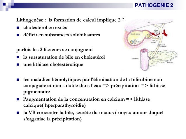 Cholecystite aigue lithiasique