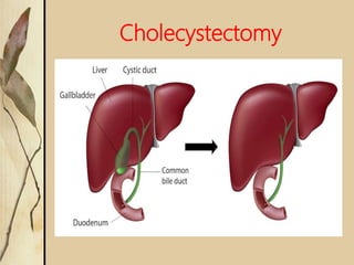 Cholecystectomy
 