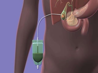 Cholecystitis and cholelithiasis 