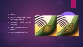 ▶ Lithotripsy
▶ Extracorporeal shock wave
lithotripsy (ESWL)
▶ 1500 shock waves directed
at stones
▶ Used for fewer than 4
stones,
▶ each smaller than 3cm.
 
