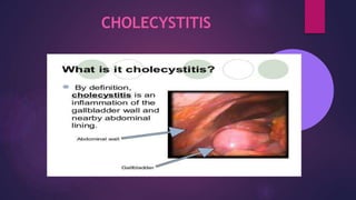 CHOLECYSTITIS
 