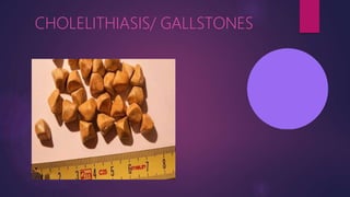 CHOLELITHIASIS/ GALLSTONES
 