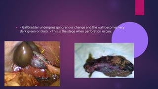▶ - Gallbladder undergoes gangrenous change and the wall becomes very
dark green or black. - This is the stage when perforation occurs.
 