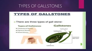 TYPES OF GALLSTONES
 