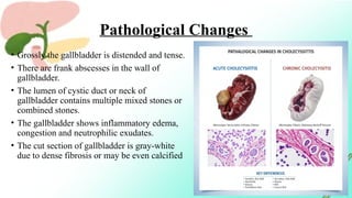 CHOLECYSTITIS.pptx a condition includes stone in gallbladder | PPTX