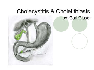 Cholecystitis & Cholelithiasis
by: Gari Glaser
 