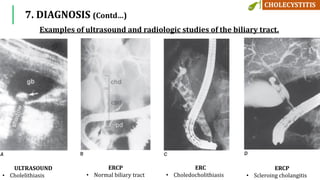 7. DIAGNOSIS (Contd…)
ULTRASOUND
• Cholelithiasis
ERCP
• Normal biliary tract
ERC
• Choledocholithiasis
ERCP
• Scleroing cholangitis
Examples of ultrasound and radiologic studies of the biliary tract.
 