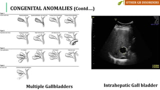 Multiple Gallbladders Intrahepatic Gall bladder
CONGENITAL ANOMALIES (Contd….)
 