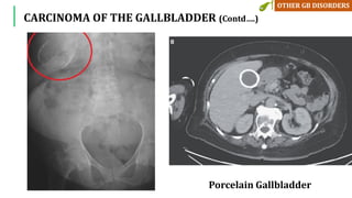 Porcelain Gallbladder
CARCINOMA OF THE GALLBLADDER (Contd….)
 