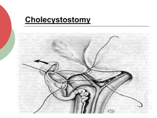 Cholecystostomy
 