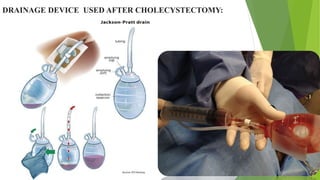 DRAINAGE DEVICE USED AFTER CHOLECYSTECTOMY:
 