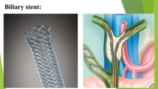 Biliary stent:
 