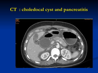 CT : choledocal cyst and pancreatitis
CT : choledocal cyst and pancreatitis
 