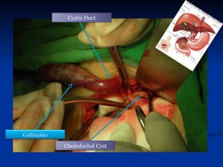 Cystic Duct
Gallbladder
Choledochal Cyst
 