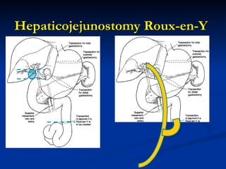 Hepaticojejunostomy Roux-en-Y
Hepaticojejunostomy Roux-en-Y
 