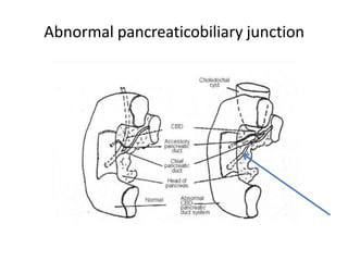 Abnormal pancreaticobiliary junction
 