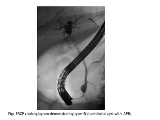 CHOLEDOCHAL CYST DIAGNOSIS AND TREATMENT | PPTX