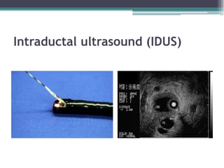 Intraductal ultrasound (IDUS)
 