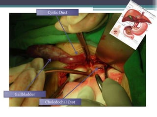 Cystic Duct
Gallbladder
Choledochal Cyst
 