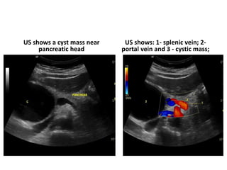 US shows a cyst mass near
pancreatic head
US shows: 1- splenic vein; 2-
portal vein and 3 - cystic mass;
 