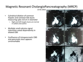 Magnetic Resonant CholangioPancreatography (MRCP)
13-01-2015
• Cylindrical dilation of common
hepatic and common bile ducts
measuring upto 3.8 cm in diameter
– Right and left heaptic ducts are normal
in calibre and outline
• Multiple small calculus signal
intensities noted dependently in
dilated CBD
• Confluence of intrapancreatic CBD
and pancreatic duct appears
unremarkable
 