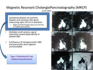 Magnetic Resonant CholangioPancreatography (MRCP)
13-01-2015
• Cylindrical dilation of common
hepatic and common bile ducts
measuring upto 3.8 cm in diameter
– Right and left heaptic ducts are normal
in calibre and outline
• Multiple small calculus signal
intensities noted dependently in
dilated CBD
• Confluence of intrapancreatic CBD
and pancreatic duct appears
unremarkable
Type I Choledochal Cyst
(Todani Classification)
 