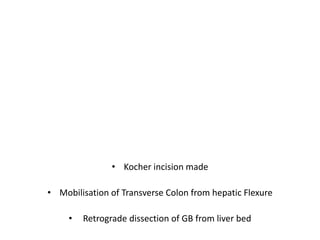 • Kocher incision made
• Mobilisation of Transverse Colon from hepatic Flexure
• Retrograde dissection of GB from liver bed
 