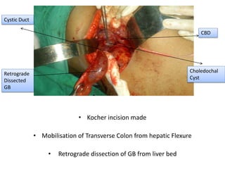 • Kocher incision made
• Mobilisation of Transverse Colon from hepatic Flexure
• Retrograde dissection of GB from liver bed
Retrograde
Dissected
GB
Cystic Duct
Choledochal
Cyst
CBD
 