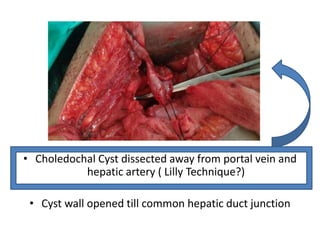 • Choledochal Cyst dissected away from portal vein and
hepatic artery ( Lilly Technique?)
• Cyst wall opened till common hepatic duct junction
 