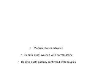 • Multiple stones extruded
• Hepatic ducts washed with normal saline
• Hepatic ducts patency confirmed with bougies
 