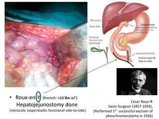 • Roux-en-Y (french: rōō'ěn-wī')
Hepatojejunostomy done
(retrocolic isoperistaltic functional side-to-side)
Cesar Roux
Swiss Surgeon (1857-1934),
(Performed 1st successful excision of
pheochromocytoma in 1926)
(End-to-side)
(End-to-side OR
Side-to-side)
 