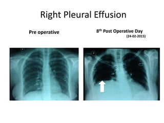 Right Pleural Effusion
Pre operative 8th Post Operative Day
(24-02-2015)
 