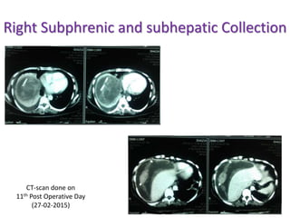 Right Subphrenic and subhepatic Collection
CT-scan done on
11th Post Operative Day
(27-02-2015)
 